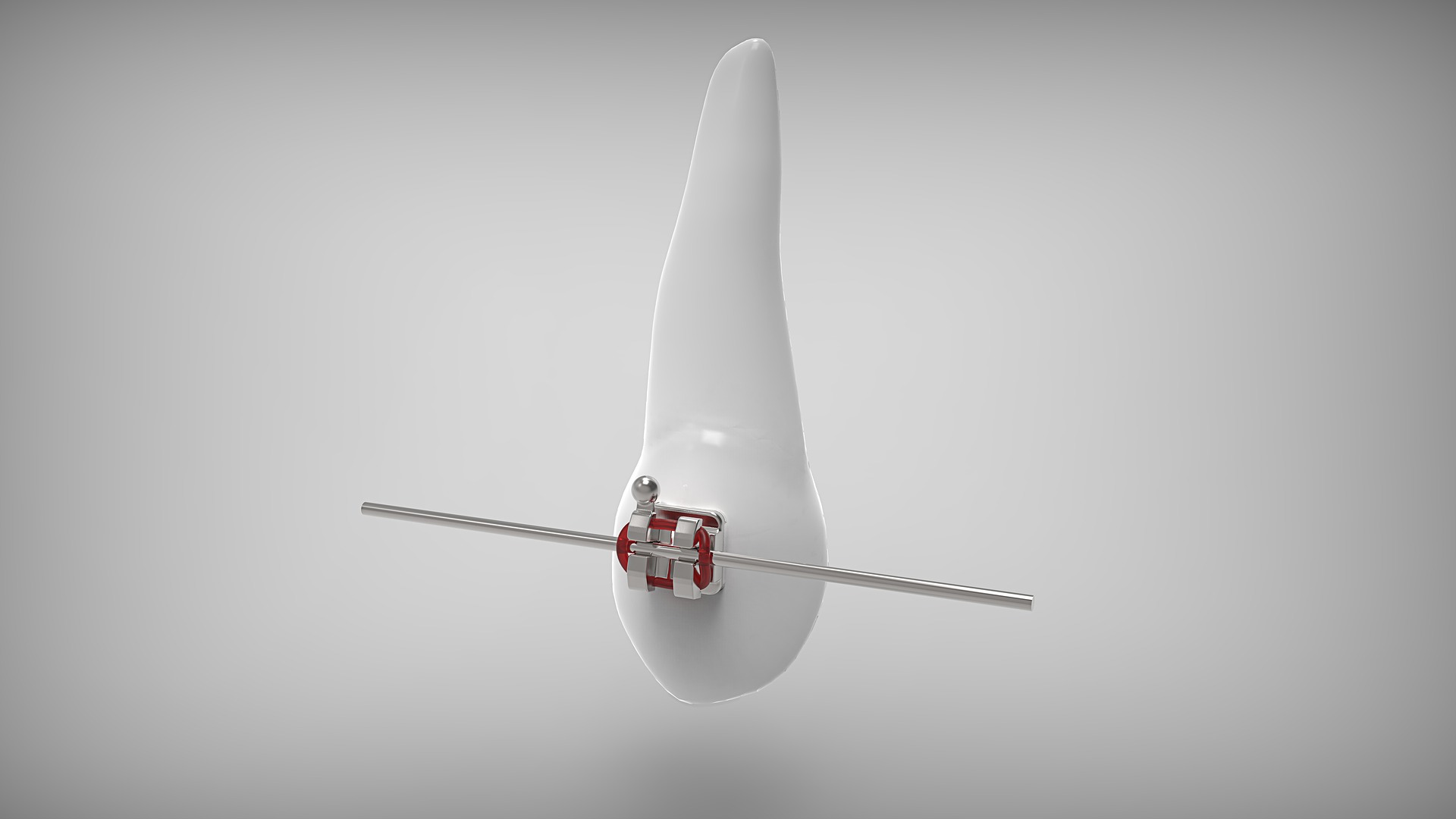 ПРИНЦИП РОБОТИ БРЕКЕТ-СИСТЕМИ