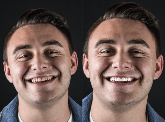 Професійна чистка і вініри