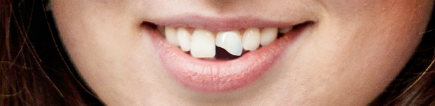 Реставрація зуба 2