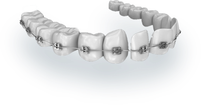 ВИПРАВЛЕННЯ ПРИКУСУ